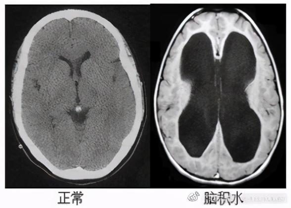 頭里積水的秘密